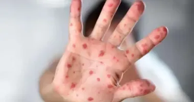У Дніпрі зафіксували спалах кору