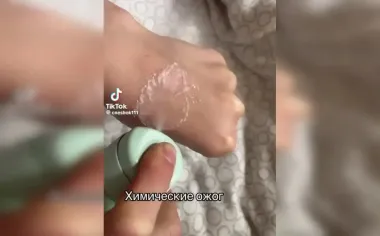 Прожгла руку дезодорантом: 12-летняя девочка повторила опасный тренд в TikTok (фото, видео)