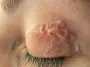 После укуса комара у женщины под веком глаза завелся червь: фото