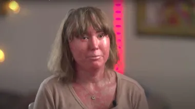 Похожа на чешуйчатую змею: женщину с редким заболеванием буллили, но она смогла это пережить (фото)