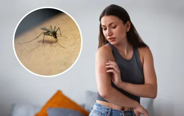 Укусы насекомых летом: как отличить, чем лечить и когда срочно к врачу