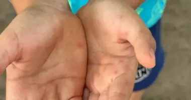В Кривом Роге 5-летний ребенок подхватил опасный вирус Коксаки: что известно