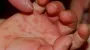 Measles cases surge to nearly 1,200 in Ukraine this year – Kuzin