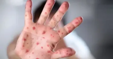 1300 випадків кору за сім місяців: де в Україні ситуація найгірша