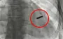In Kyiv, an Azovstal defender who spent year in captivity with bullet in his heart underwent successful surgery. VIDEO