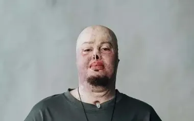 "I lost my old self but I am creating new one." Story of war veteran Yehor Babenko, who suffered severe burns in war. VIDEO+PHOTOS