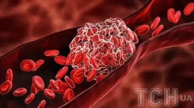 Яка їжа руйнує судини: нею зловживає кожен