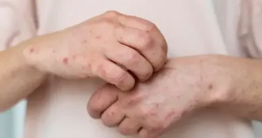 Ветрянка в колледже Ивано-Франковска: часть студентов на дистанционке