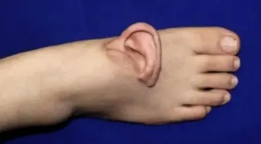 Хирурги пришили женщине ухо к стопе: что произошло (фото)