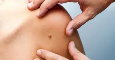 Украина закупила инновационный препарат для лечения пациентов с меланомой